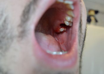 What to Expect During Wisdom Teeth Removal