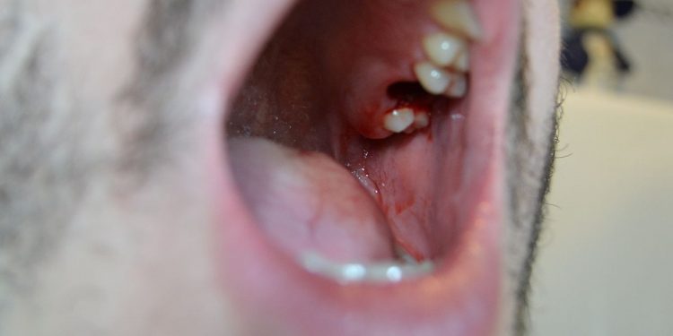 What to Expect During Wisdom Teeth Removal