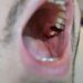 What to Expect During Wisdom Teeth Removal