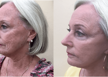 5 different strategies adopted during facelift surgeries