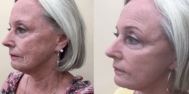 5 different strategies adopted during facelift surgeries