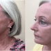 5 different strategies adopted during facelift surgeries