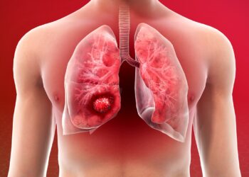 10 Facts Everyone Should Know About Lung Cancer