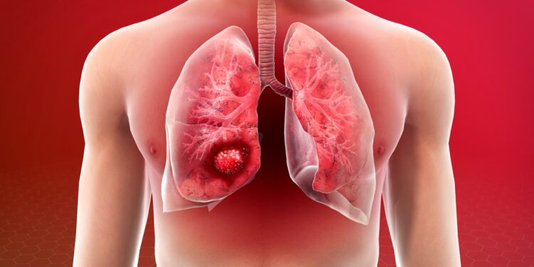 10 Facts Everyone Should Know About Lung Cancer