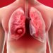 10 Facts Everyone Should Know About Lung Cancer